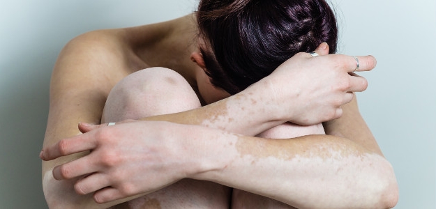 Vitiligo – nevyliečiteľné ochorenie?